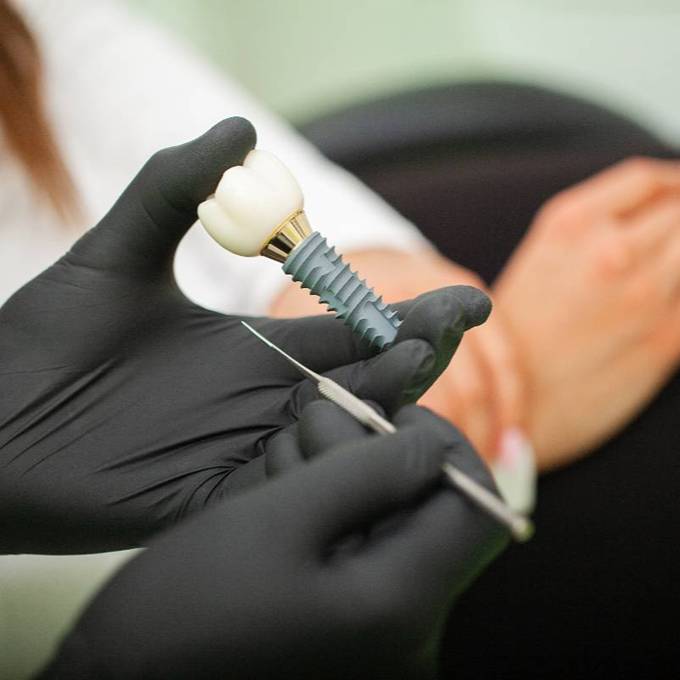 Implantes dentales